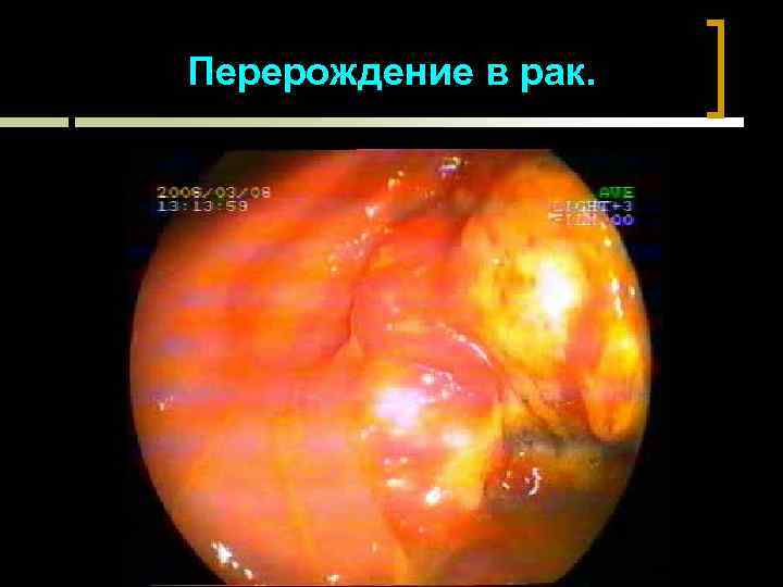 Перерождение в рак. 