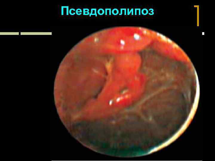 Псевдополипоз 