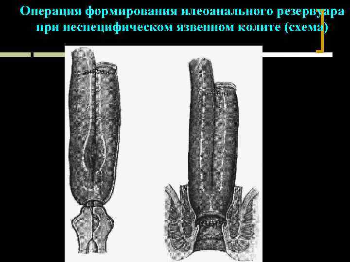 Операция формирования илеоанального резервуара при неспецифическом язвенном колите (схема) 