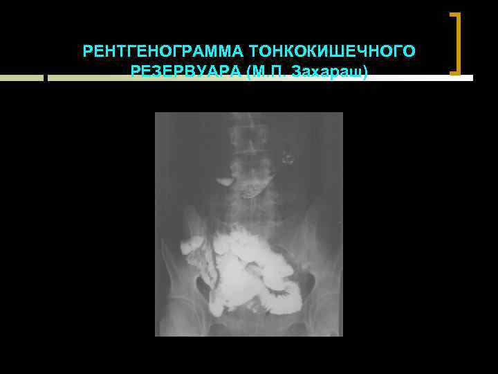РЕНТГЕНОГРАММА ТОНКОКИШЕЧНОГО РЕЗЕРВУАРА (М. П. Захараш) 