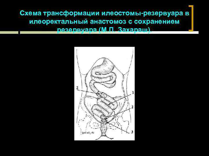 Схема трансформации илеостомы-резервуара в илеоректальный анастомоз с сохранением резервуара (М. П. Захараш). 