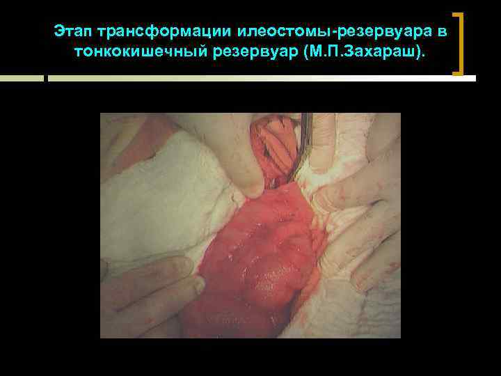 Этап трансформации илеостомы-резервуара в тонкокишечный резервуар (М. П. Захараш). 