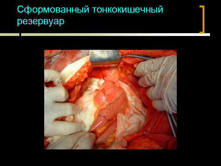 Сформованный тонкокишечный резервуар 