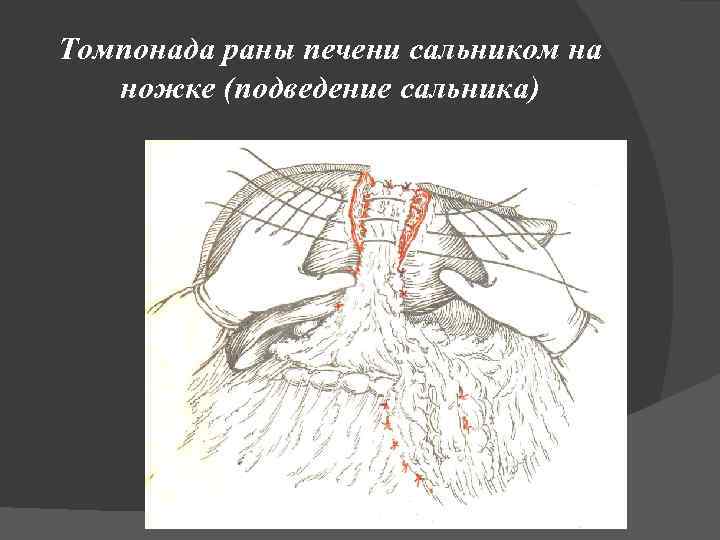 Томпонада раны печени сальником на ножке (подведение сальника) 