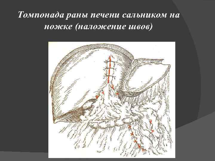 Томпонада раны печени сальником на ножке (наложение швов) 