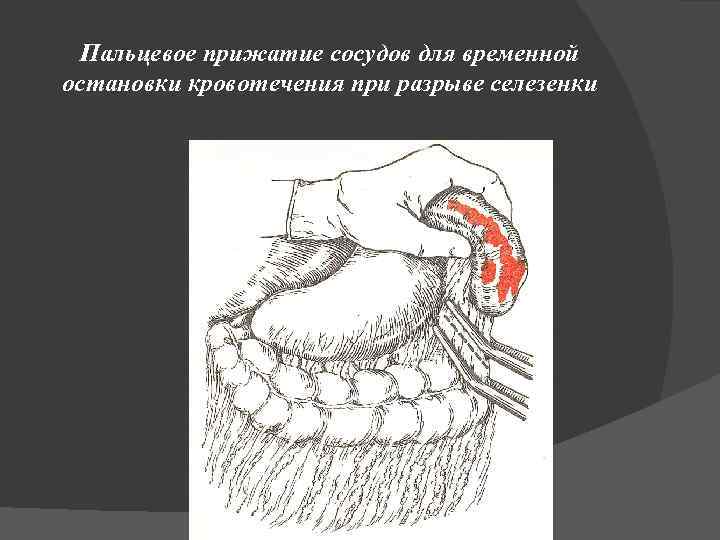 Пальцевое прижатие сосудов для временной остановки кровотечения при разрыве селезенки 