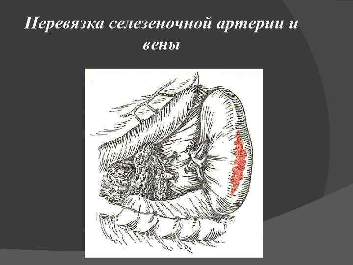 Перевязка селезеночной артерии и вены 