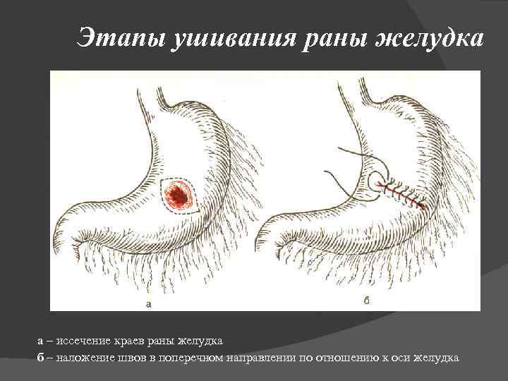 Этапы ушивания раны желудка а – иссечение краев раны желудка б – наложение швов