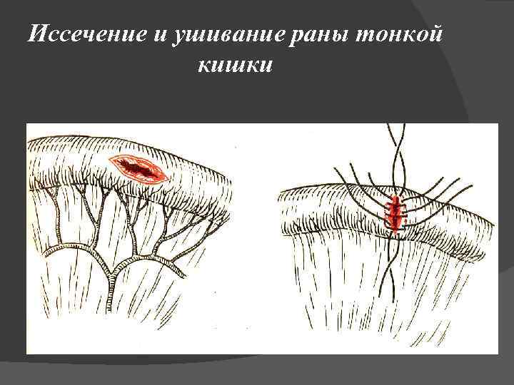 Иссечение и ушивание раны тонкой кишки 