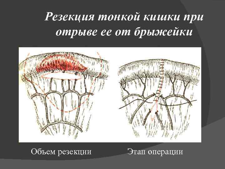 Резекция тонкой кишки при отрыве ее от брыжейки Объем резекции Этап операции 