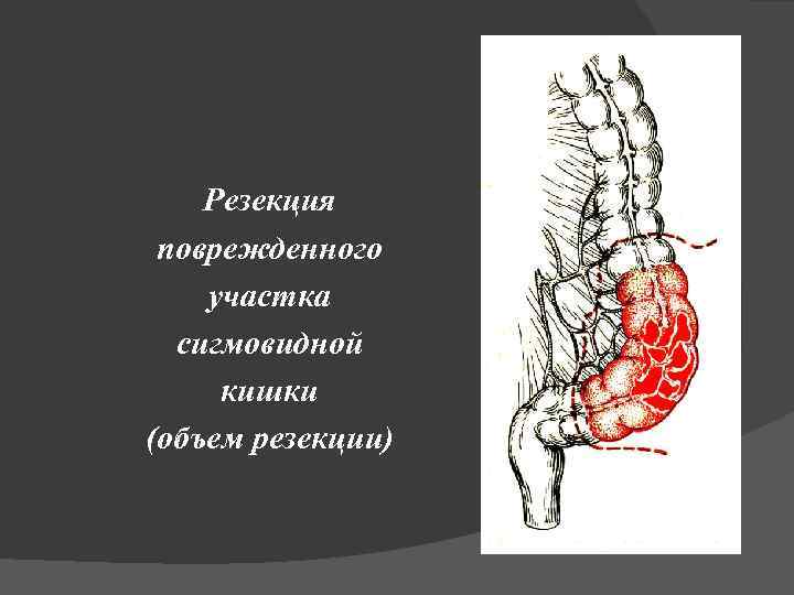 Резекция поврежденного участка сигмовидной кишки (объем резекции) 