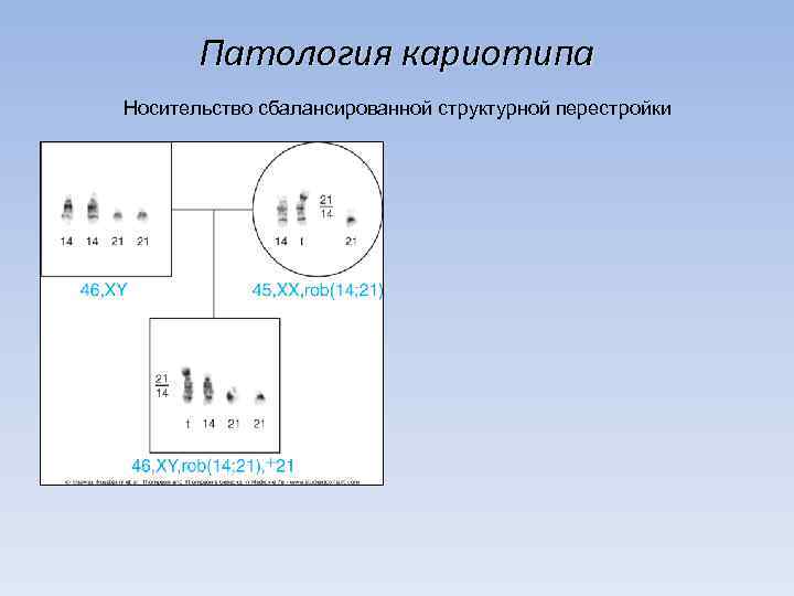 Патология кариотипа Носительство сбалансированной структурной перестройки 