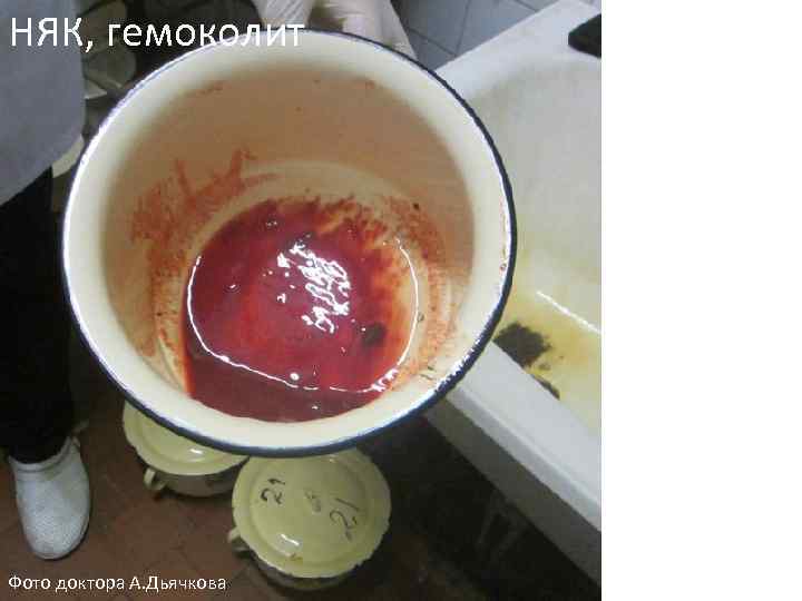 НЯК, гемоколит Фото доктора А. Дьячкова 