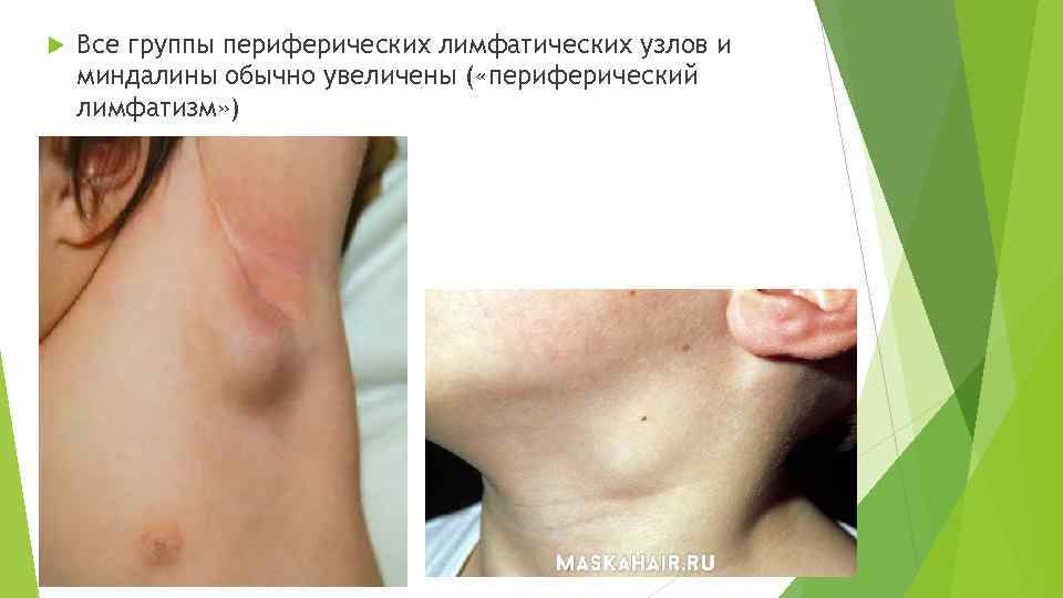  Все группы периферических лимфатических узлов и миндалины обычно увеличены ( «периферический лимфатизм» )