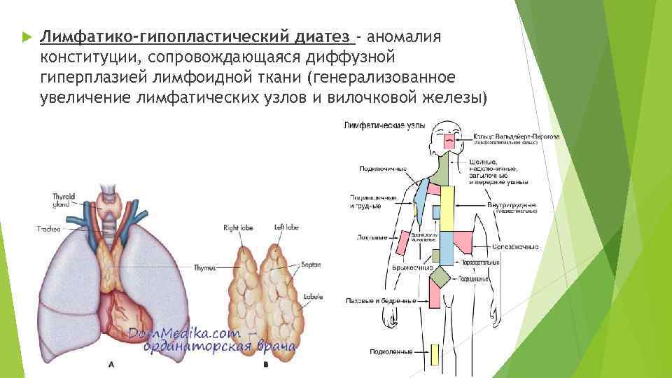 Лимфатико гипопластический диатез фото