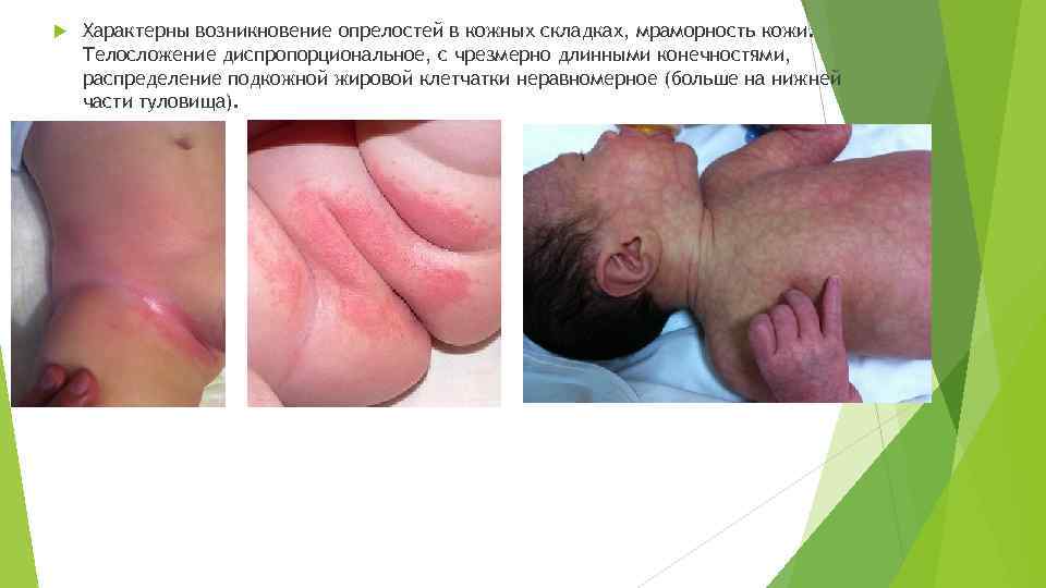  Характерны возникновение опрелостей в кожных складках, мраморность кожи. Телосложение диспропорциональное, с чрезмерно длинными