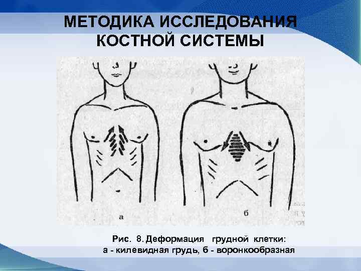 Рахитическая грудная клетка рисунок схематично