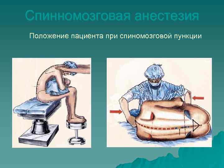 Спинномозговая анестезия Положение пациента при спиномозговой пункции 