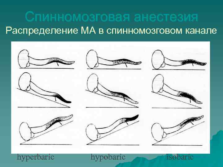 Спинномозговая анестезия Распределение МА в спинномозговом канале hyperbaric hypobaric isobaric 