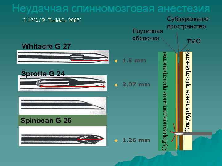 Неудачная спинномозговая анестезия Паутинная оболочка Субдуральное пространство u 1. 5 mm u 3. 07