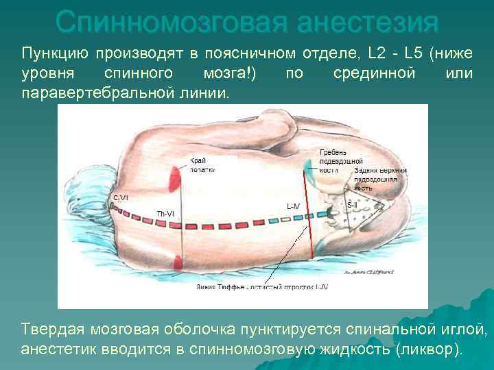 Спинномозговая анестезия Пункцию производят в поясничном отделе, L 2 - L 5 (ниже уровня