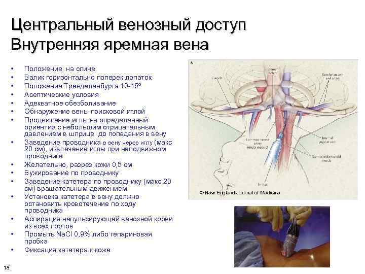 Центральный венозный доступ Внутренняя яремная вена • • • • 18 Положение: на спине