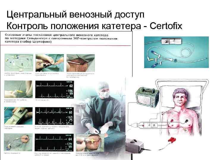 Центральный венозный доступ Контроль положения катетера - Certofix 25 