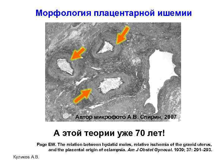 Морфология плацентарной ишемии Автор микрофото А. В. Спирин, 2007 А этой теории уже 70
