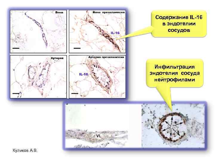 Содержание IL-16 в эндотелии сосудов Инфильтрация эндотелия сосуда нейтрофилами Куликов А. В. 