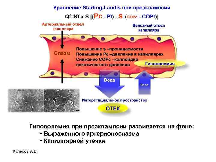 Гиповолемия при преэклампсии развивается на фоне: • Выраженного артериолоспазма • Капиллярной утечки Куликов А.