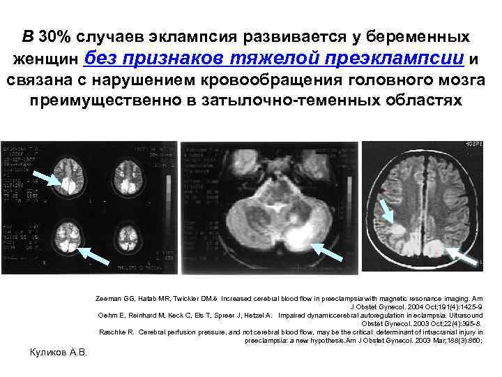 В 30% случаев эклампсия развивается у беременных женщин без признаков тяжелой преэклампсии и связана