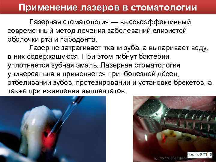 Применение лазеров в стоматологии Лазерная стоматология — высокоэффективный современный метод лечения заболеваний слизистой оболочки