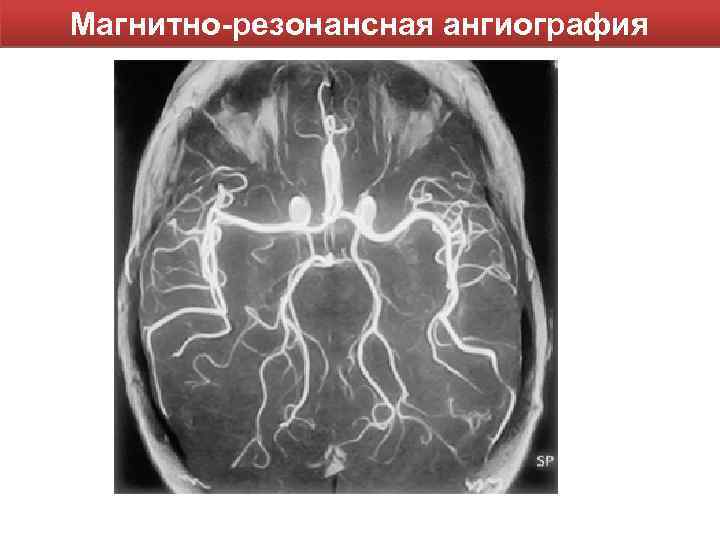 Магнитно-резонансная ангиография 