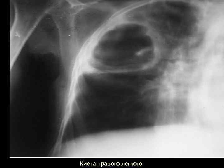 Киста правого легкого 