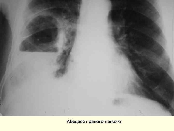Абсцесс правого легкого 