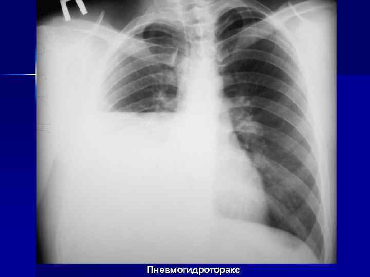 Пневмогидроторакс 