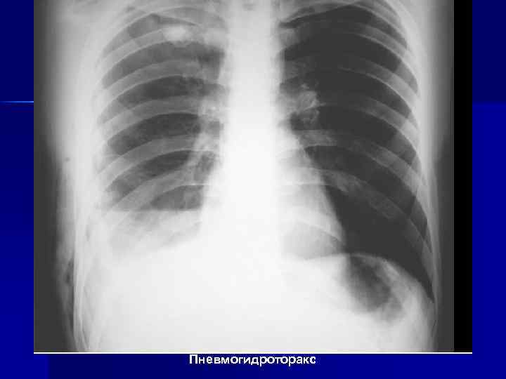 Пневмогидроторакс 