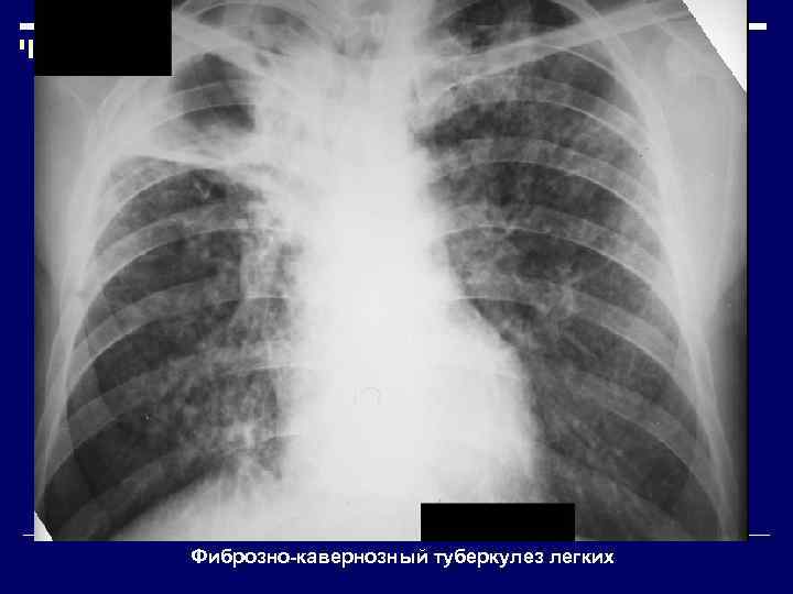 Фиброзно-кавернозный туберкулез легких 