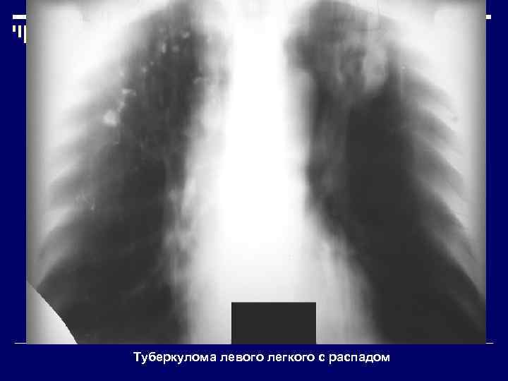 Туберкулома левого легкого с распадом 