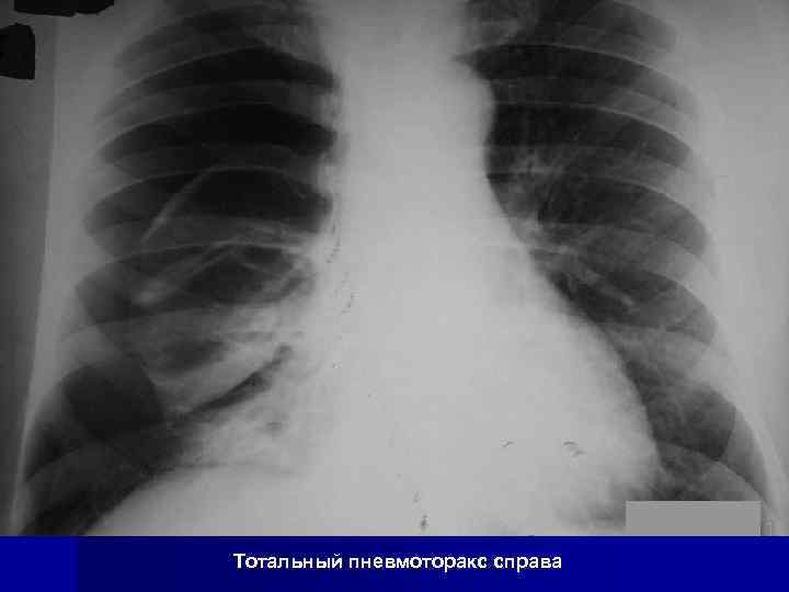 Тотальный пневмоторакс справа 