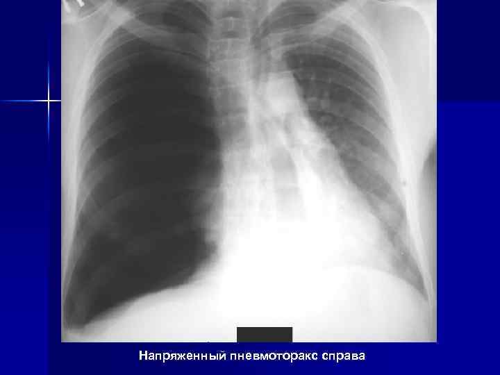 Напряженный пневмоторакс справа 