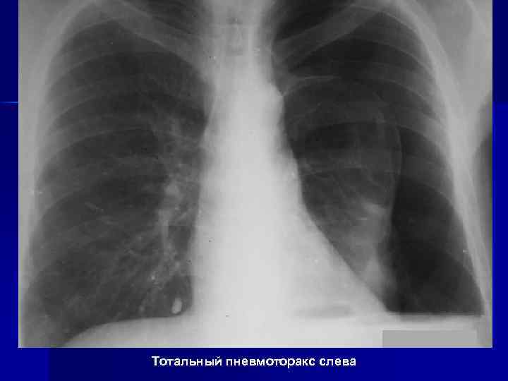 Тотальный пневмоторакс слева 