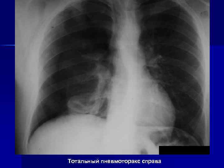 Тотальный пневмоторакс справа 
