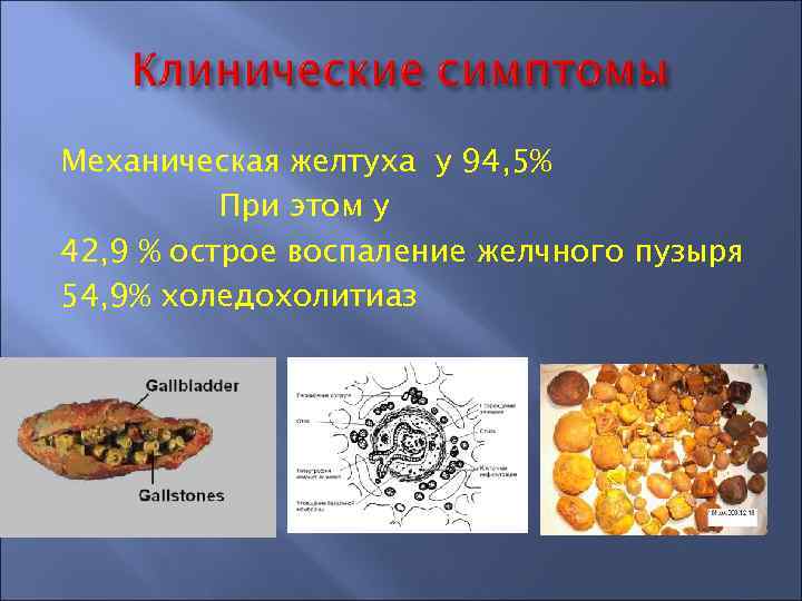 Механическая желтуха у 94, 5% При этом у 42, 9 % острое воспаление желчного