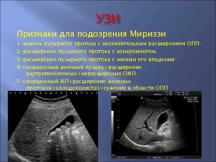 Признаки для подозрения Мириззи 1 -камень пузырного протока с незначительным расширением ОПП. 2 -расширение