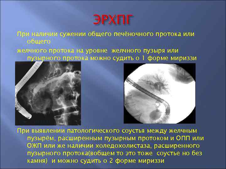 При наличии сужении общего печёночного протока или общего желчного протока на уровне желчного пузыря