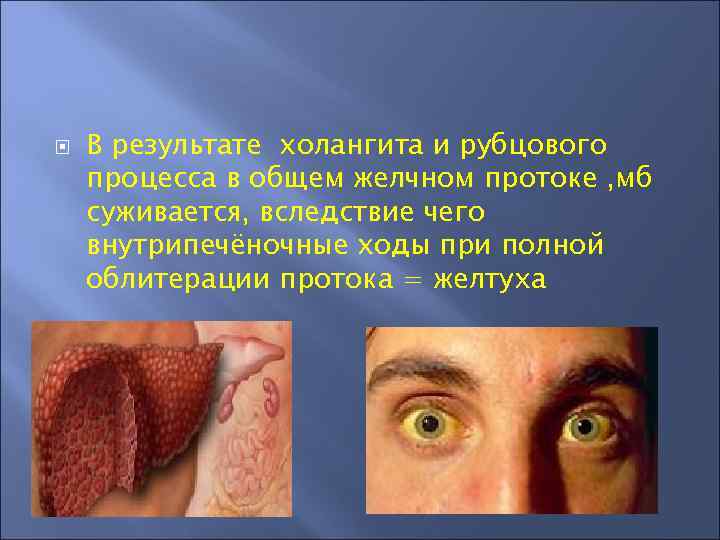  В результате холангита и рубцового процесса в общем желчном протоке , мб суживается,