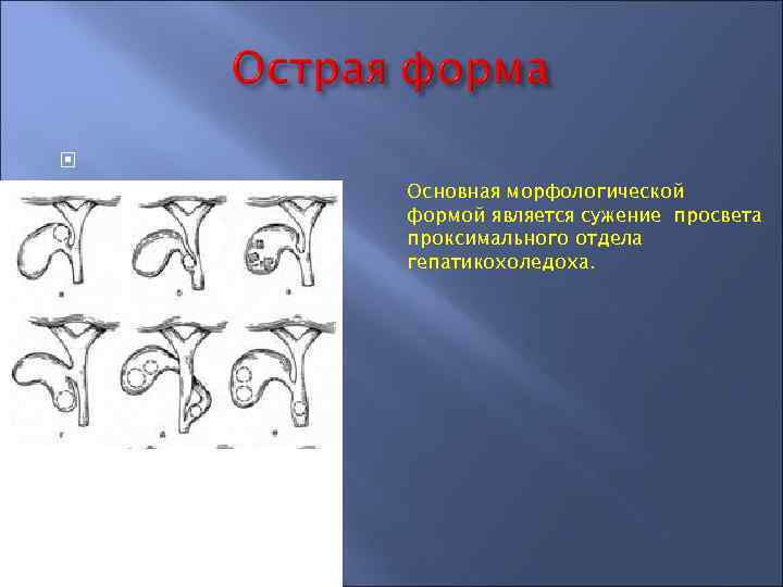  Основная морфологической формой является сужение просвета проксимального отдела гепатикохоледоха. 