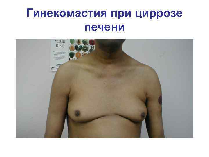 Гинекомастия при циррозе печени 