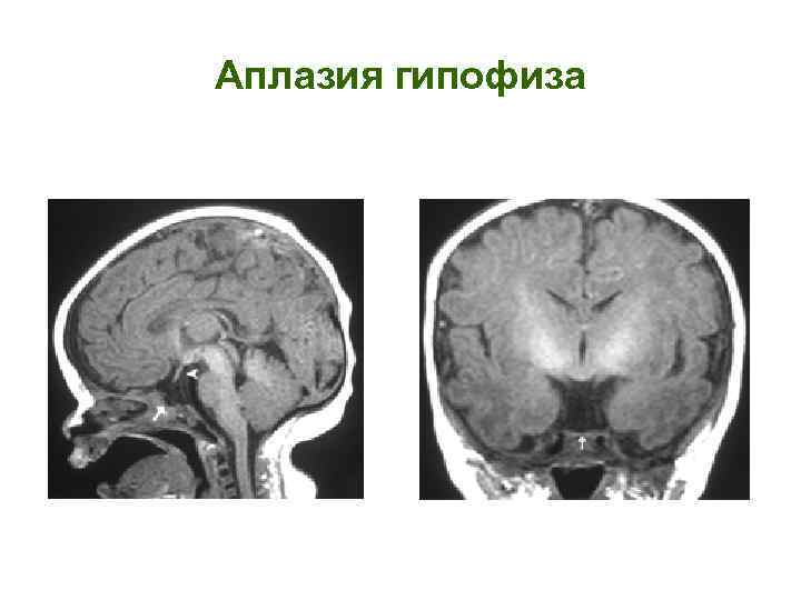 Аплазия гипофиза 